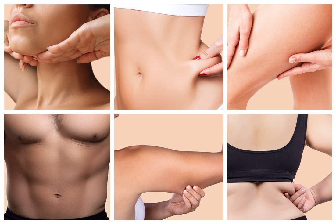 Laser Lipo Liposuction Lexington MA